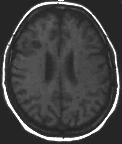 Encephalomyelitis disseminata T1