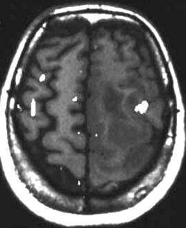 Motorfunktion bei Gliom, T1 mit Einblendung f-MRI