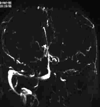 vense MR-Angiographie bei Sinusvenenthrombose