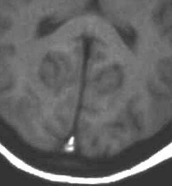 MRI-Library: Sinusvenenthrombose