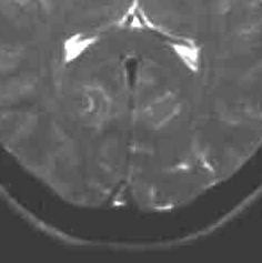 Thrombose des Sinus sagittalis occipitalis T2