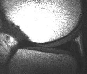 normaler Auenmeniskus, T1 sagittal, Oberflchenspule