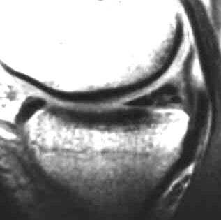 Ruptur des Hinterhornes des  Auenmeniskus, T1 sagittal