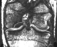 Osteochondrose, 3D-Sequenz, 1 mm Schichtdicke, coronal