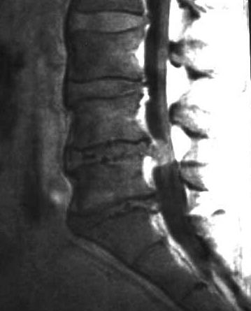 Bandscheibenprolaps LWK 4/5, T1 sagittal